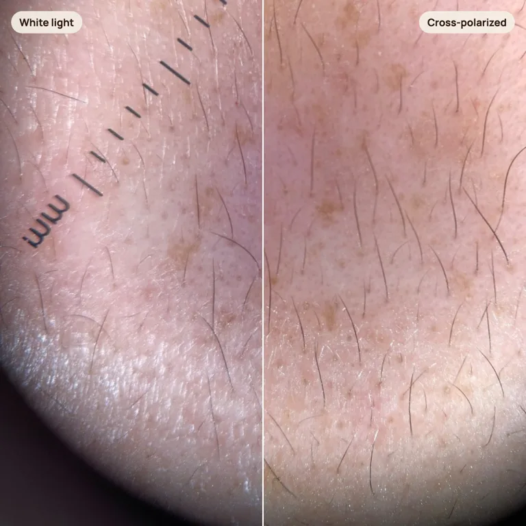One macro patch of cheek skin split down the middle: the left half under white light shows a band of glare along the bottom, the right half under cross-polarized light shows the same kind of skin with the shine gone and fine texture and pigment visible.
